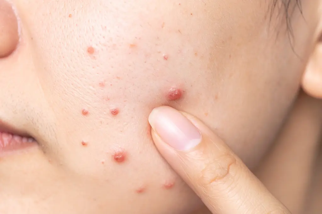 Acne & Skin Breakouts