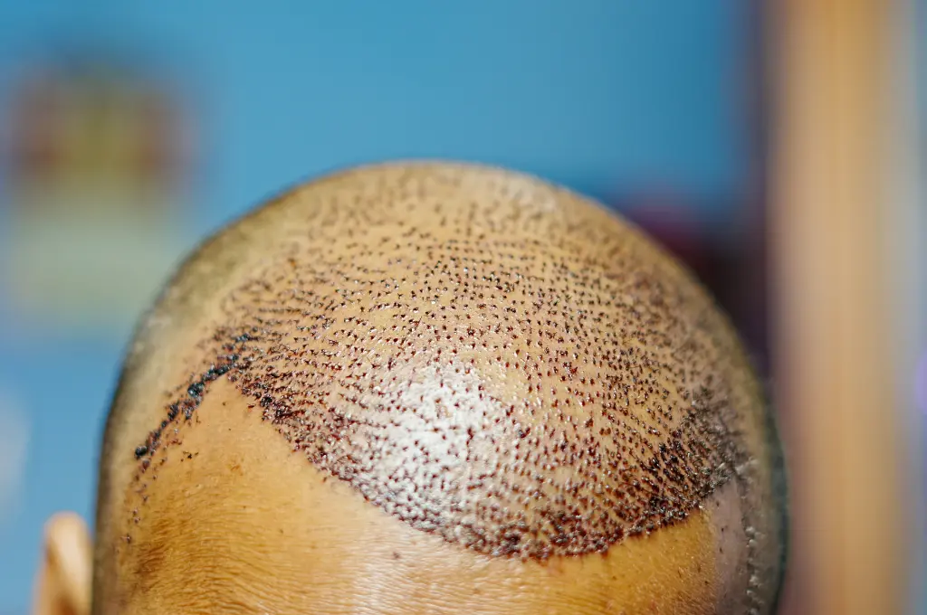 Hair Transplant